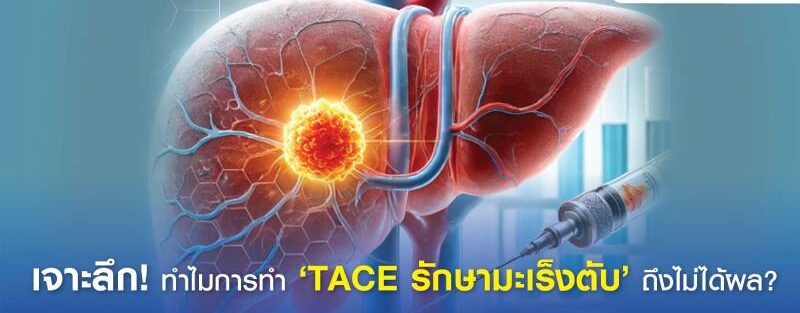 ภาพประกอบของขั้นตอน Transarterial Chemoembolization (TACE) สำหรับการรักษามะเร็งตับ แสดงให้เห็นการส่งเคมีบำบัดโดยตรงไปยังเนื้องอกในตับ และหลอดเลือดถูกปิดกั้นเพื่อตัดปริมาณเลือดของเนื้องอก
