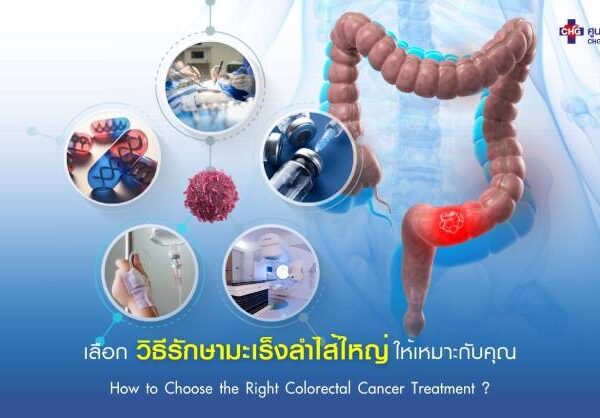 เลือกวิธีรักษามะเร็งลำไส้ใหญ่ให้เหมาะกับคุณ