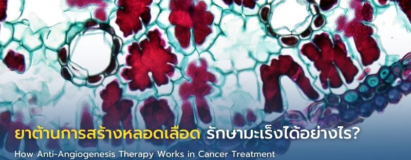 Anti-Angiogenesis Therapy กับบทบาทในการรักษามะเร็ง โดยการตัดเส้นทางหลอดเลือดของเซลล์มะเร็ง ลดการเติบโตและแพร่กระจายของโรค