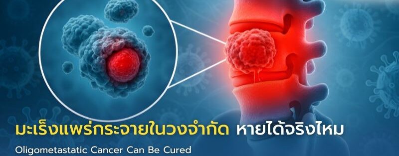 อินโฟกราฟิกแสดงแนวทางการรักษามะเร็งแพร่กระจายในวงจำกัด เช่น ผ่าตัด ฉายแสง และยาเฉพาะทาง พร้อมภาพร่างกายมนุษย์และจุดมะเร็ง