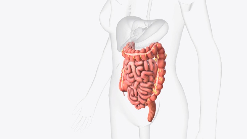 ภาพอธิบายการผ่าตัด APR สำหรับมะเร็งลำไส้ตรงและทวารหนัก ที่อาจต้องเปิดรูทวารถาวรหลังผ่าตัด