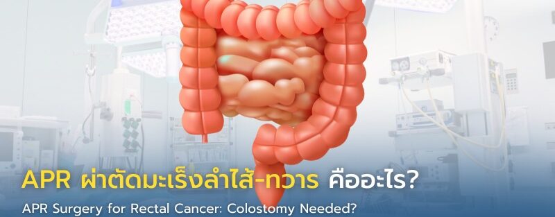 ภาพอธิบายการผ่าตัด APR สำหรับมะเร็งลำไส้ตรงและทวารหนัก ที่อาจต้องเปิดรูทวารถาวรหลังผ่าตัด