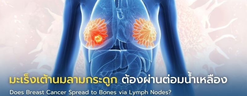 อินโฟกราฟิกอธิบายเส้นทางการแพร่กระจายของมะเร็งเต้านมจากต่อมน้ำเหลืองไปยังกระดูก พร้อมอธิบายข้อยกเว้นและอาการเตือน