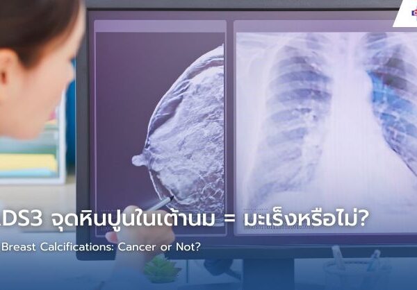 BIRADS3 จุดหินปูนในเต้านม = มะเร็งหรือไม่?
