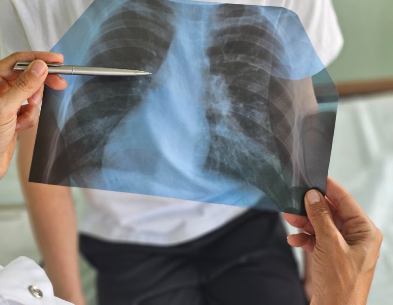 ขั้นตอนการวินิจฉัยมะเร็งปอด เริ่มจาก CT Scan ตรวจชิ้นเนื้อ และตรวจยีน เพื่อเลือกวิธีรักษาที่แม่นยำและเหมาะสมกับผู้ป่วย