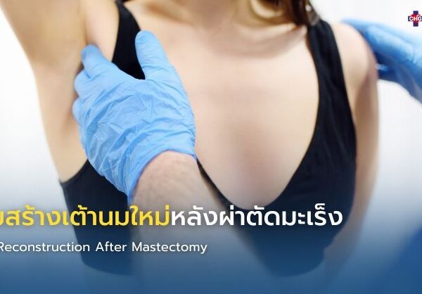 เสริมสร้างเต้านมใหม่หลังผ่าตัดมะเร็ง