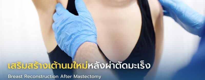 อินโฟกราฟิกหัวข้อ Breast Reconstruction After Mastectomy แสดงตัวเลือกการเสริมเต้านมใหม่ ได้แก่ ซิลิโคน เนื้อเยื่อตัวเอง หรือแบบผสม พร้อมช่วงเวลาที่ทำได้ (ทันทีหรือภายหลัง) และประโยชน์ เช่น ฟื้นความมั่นใจ สมดุลร่างกาย และคุณภาพชีวิต
