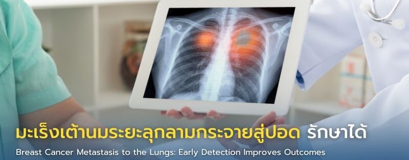 ภาพก้อนมะเร็งเต้านมลุกลามเข้าสู่ปอด มองเห็นตำแหน่งการกระจายชัดเจน