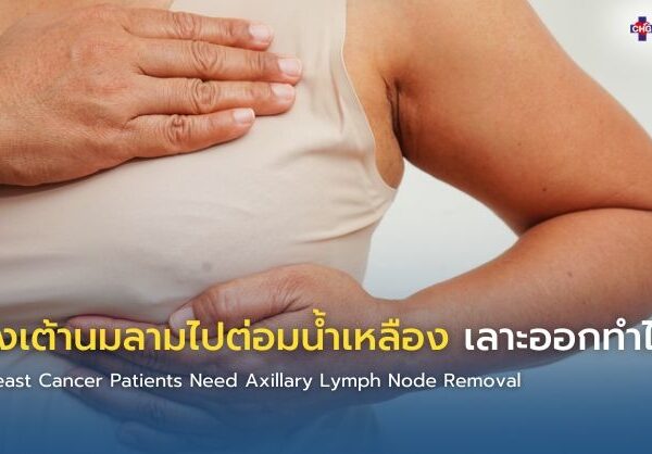 มะเร็งเต้านมลามไปต่อมน้ำเหลือง เลาะออกทำไม