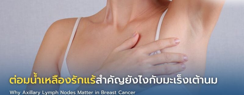 ภาพแสดงตำแหน่งต่อมน้ำเหลืองรักแร้และความสำคัญในการประเมินการกระจายของมะเร็งเต้านมและการวางแผนการรักษา