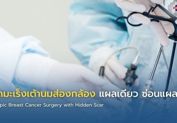 ผ่าตัดมะเร็งเต้านมส่องกล้อง แผลเดียว ซ่อนแผลสวย