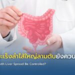สัญญาณมะเร็งลำไส้ใหญ่ลามตับยังควบคุมโรคได้