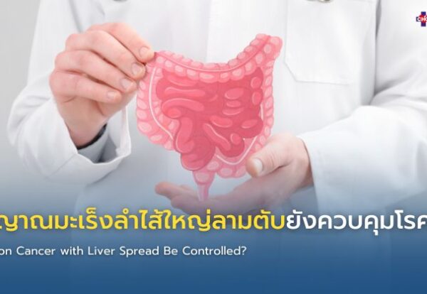 อินโฟกราฟิกแสดงสัญญาณที่บ่งชี้ว่ามะเร็งลำไส้ใหญ่ที่มีการแพร่กระจายไปยังตับอยู่ภายใต้การควบคุม รวมถึงการหดตัวของเนื้องอก ระดับ CEA ที่คงที่ การทำงานของตับที่ดี และการตอบสนองต่อการรักษาในเชิงบวก