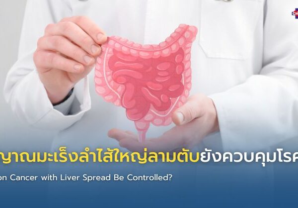 สัญญาณมะเร็งลำไส้ใหญ่ลามตับยังควบคุมโรคได้