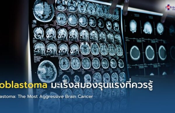 อินโฟกราฟิกแสดงข้อมูล Glioblastoma มะเร็งสมองชนิดรุนแรง พร้อมอาการเตือน การตรวจ MRI และแนวทางรักษา เช่น ผ่าตัด ฉายรังสี และเคมีบำบัด