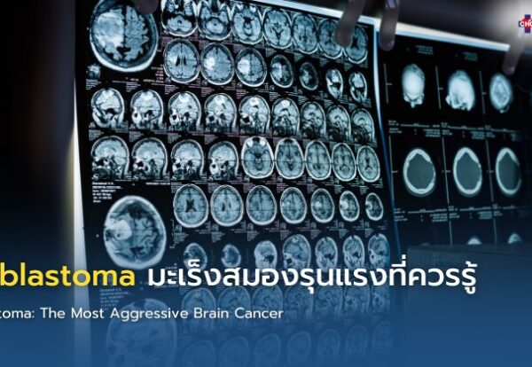 อินโฟกราฟิกแสดงข้อมูล Glioblastoma มะเร็งสมองชนิดรุนแรง พร้อมอาการเตือน การตรวจ MRI และแนวทางรักษา เช่น ผ่าตัด ฉายรังสี และเคมีบำบัด