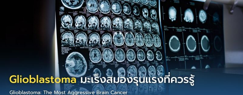 อินโฟกราฟิกแสดงข้อมูล Glioblastoma มะเร็งสมองชนิดรุนแรง พร้อมอาการเตือน การตรวจ MRI และแนวทางรักษา เช่น ผ่าตัด ฉายรังสี และเคมีบำบัด