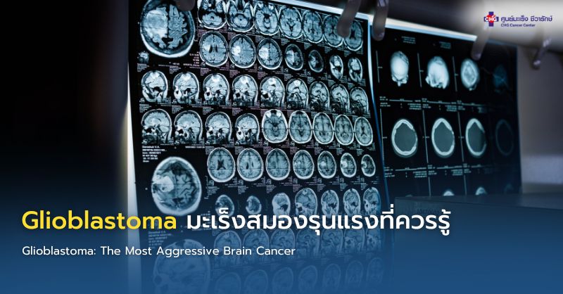 อินโฟกราฟิกแสดงข้อมูล Glioblastoma มะเร็งสมองชนิดรุนแรง พร้อมอาการเตือน การตรวจ MRI และแนวทางรักษา เช่น ผ่าตัด ฉายรังสี และเคมีบำบัด