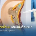 เนื้องอกในท่อน้ำนม เสี่ยงมะเร็งไหม?