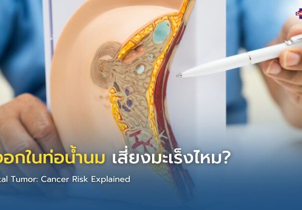 เนื้องอกในท่อน้ำนม เสี่ยงมะเร็งไหม?
