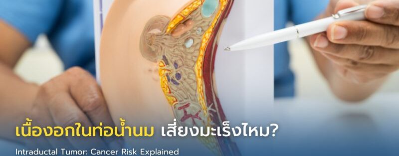 ภาพอินโฟกราฟิกแสดงโครงสร้างท่อน้ำนมและก้อนเนื้องอก พร้อมขั้นตอนการตรวจวินิจฉัยและการรักษาเนื้องอกในท่อน้ำนม