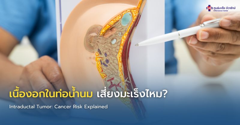 ภาพอินโฟกราฟิกแสดงโครงสร้างท่อน้ำนมและก้อนเนื้องอก พร้อมขั้นตอนการตรวจวินิจฉัยและการรักษาเนื้องอกในท่อน้ำนม