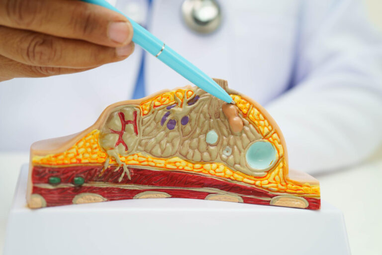 ภาพอินโฟกราฟิกแสดงโครงสร้างท่อน้ำนมและก้อนเนื้องอก พร้อมขั้นตอนการตรวจวินิจฉัยและการรักษาเนื้องอกในท่อน้ำนม