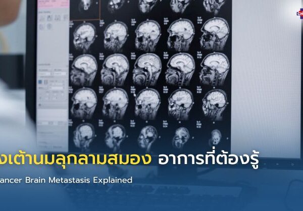 มะเร็งเต้านมลุกลามสมอง อาการที่ต้องรู้