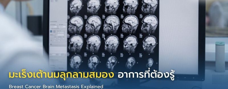 อินโฟกราฟิกอธิบายมะเร็งเต้านมลุกลามสู่สมอง แสดงตำแหน่งสมองที่พบบ่อย เช่น cerebellum และ frontal lobe พร้อมอาการปวดศีรษะ เดินเซ และแนวทางรักษา เช่น MRI ผ่าตัด และรังสีรักษา