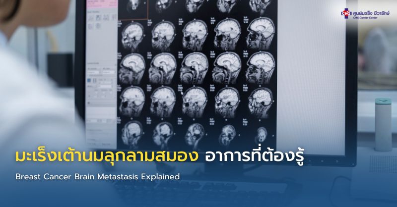 อินโฟกราฟิกอธิบายมะเร็งเต้านมลุกลามสู่สมอง แสดงตำแหน่งสมองที่พบบ่อย เช่น cerebellum และ frontal lobe พร้อมอาการปวดศีรษะ เดินเซ และแนวทางรักษา เช่น MRI ผ่าตัด และรังสีรักษา