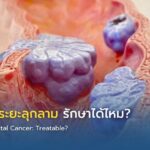 มะเร็งลำไส้ระยะลุกลาม รักษาได้ไหม?