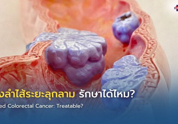 มะเร็งลำไส้ระยะลุกลาม รักษาได้ไหม?