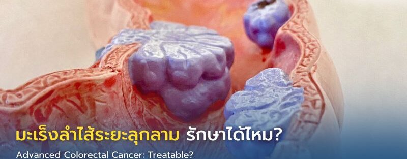 แพทย์อธิบายแนวทางรักษามะเร็งลำไส้ระยะลุกลามด้วยคีโม ยามุ่งเป้า ภูมิคุ้มกันบำบัด และการผ่าตัดแก่ผู้ป่วย