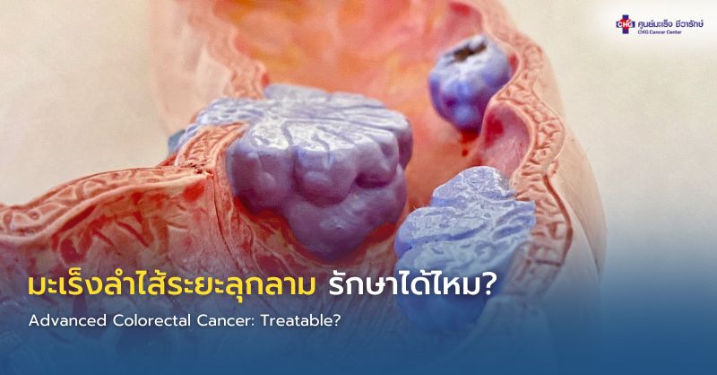 แพทย์อธิบายแนวทางรักษามะเร็งลำไส้ระยะลุกลามด้วยคีโม ยามุ่งเป้า ภูมิคุ้มกันบำบัด และการผ่าตัดแก่ผู้ป่วย