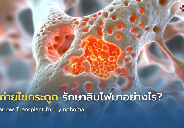 ปลูกถ่ายไขกระดูก รักษาลิมโฟมาอย่างไร?