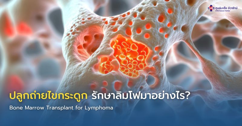 แพทย์อธิบายการปลูกถ่ายไขกระดูกเพื่อรักษามะเร็งต่อมน้ำเหลืองให้ผู้ป่วย พร้อมภาพจำลองเซลล์ต้นกำเนิดเม็ดเลือด
