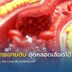มะเร็งลำไส้กระจายตับ อุดหลอดเลือดได้ไหม?