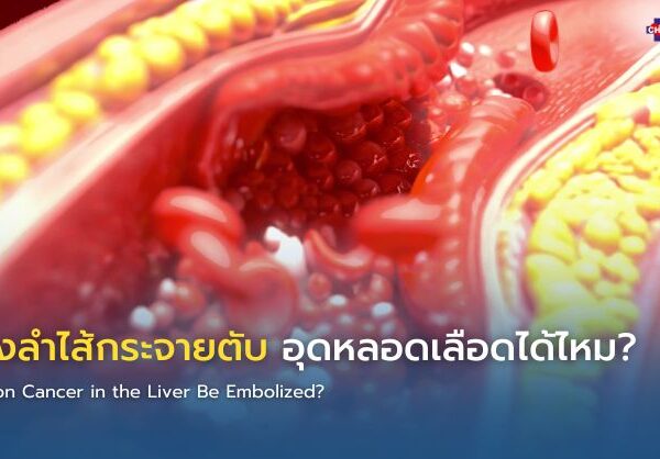 มะเร็งลำไส้กระจายตับ อุดหลอดเลือดได้ไหม?