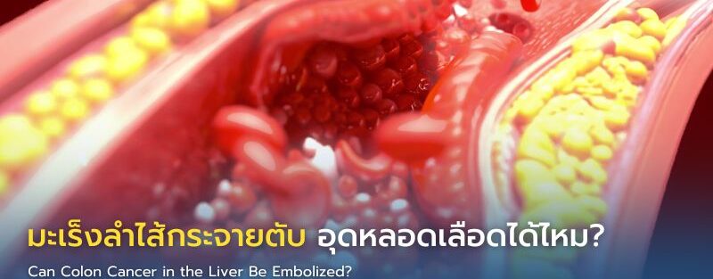 แพทย์รังสีร่วมรักษาอธิบายการอุดหลอดเลือดที่ไปเลี้ยงก้อนมะเร็งลำไส้ซึ่งแพร่กระจายไปยังตับ