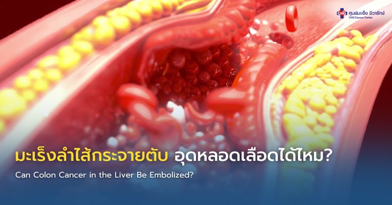 แพทย์รังสีร่วมรักษาอธิบายการอุดหลอดเลือดที่ไปเลี้ยงก้อนมะเร็งลำไส้ซึ่งแพร่กระจายไปยังตับ