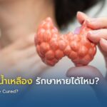 มะเร็งต่อมน้ำเหลือง รักษาหายได้ไหม?